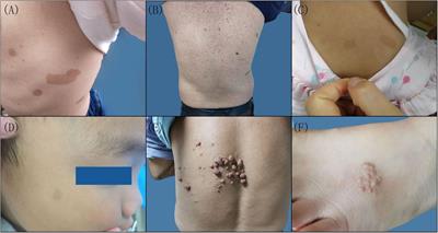 Molecular Diagnosis of Neurofibromatosis by Multigene Panel Testing